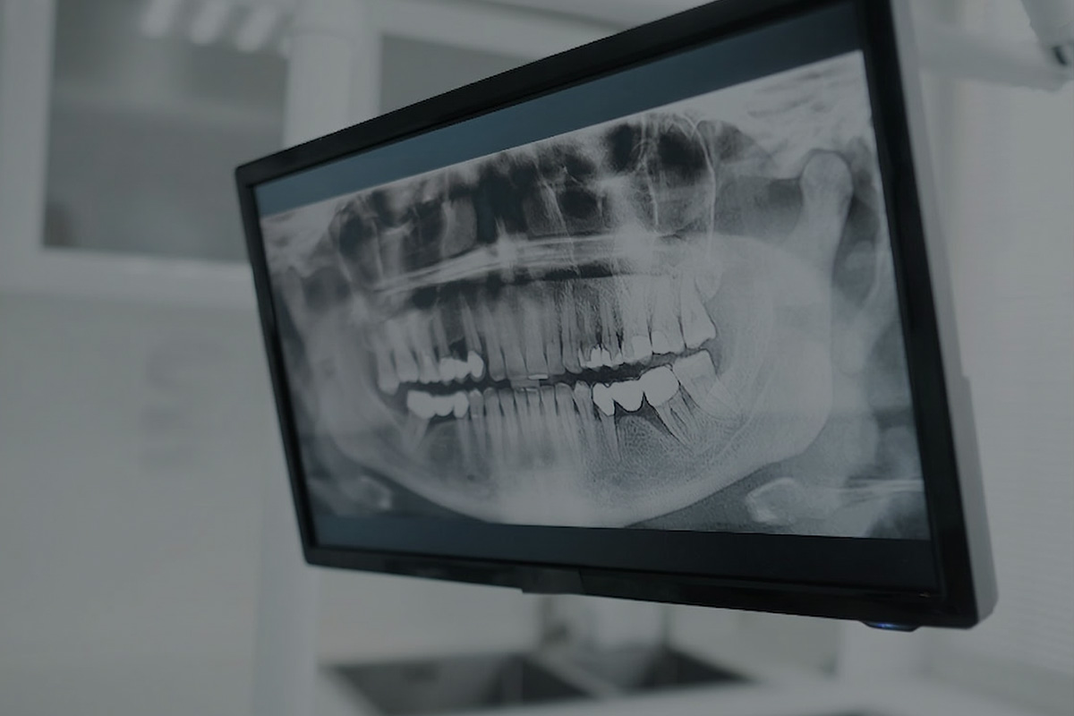 Implantes Dentales 