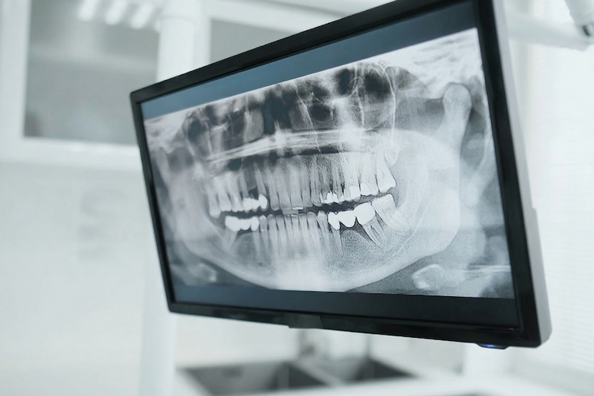 Implantes Dentales
