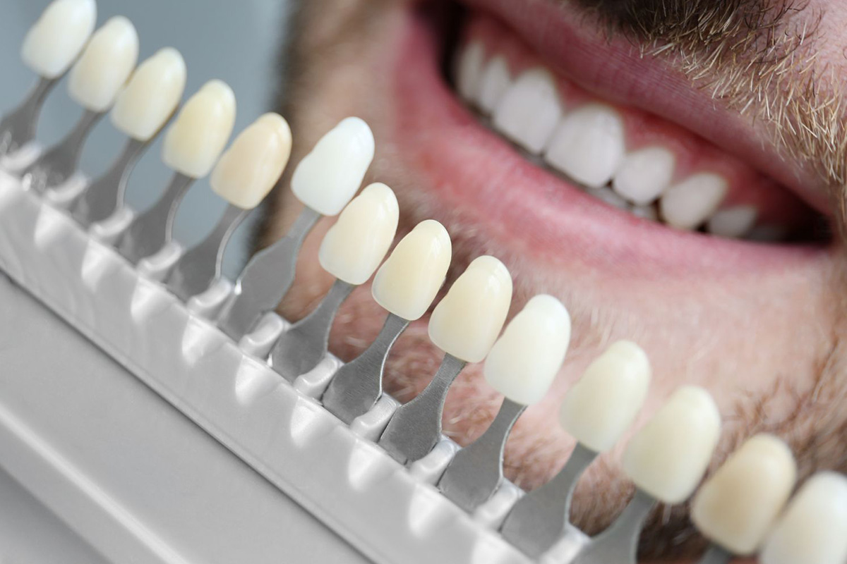 Estética Dental